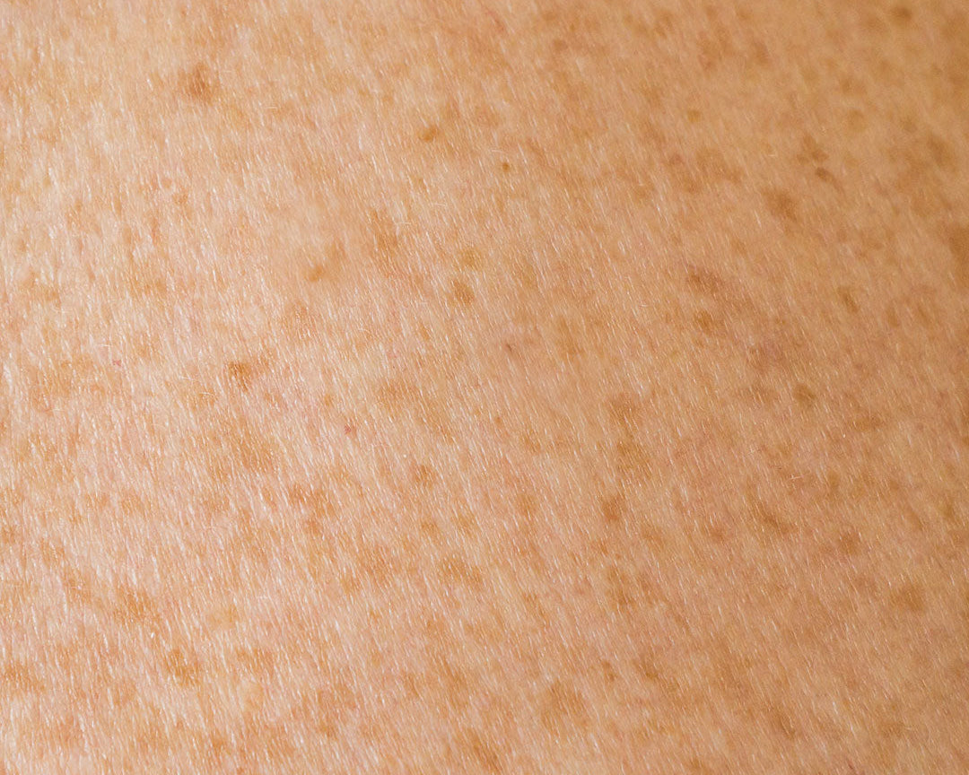 ¿Por qué se forman manchas en la piel?