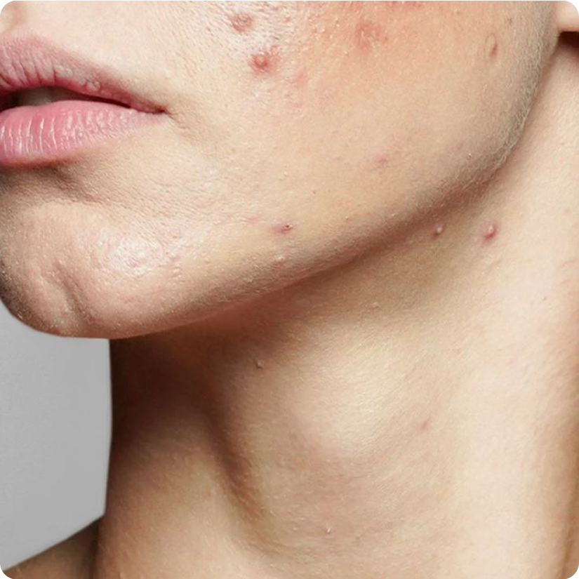 acne.png