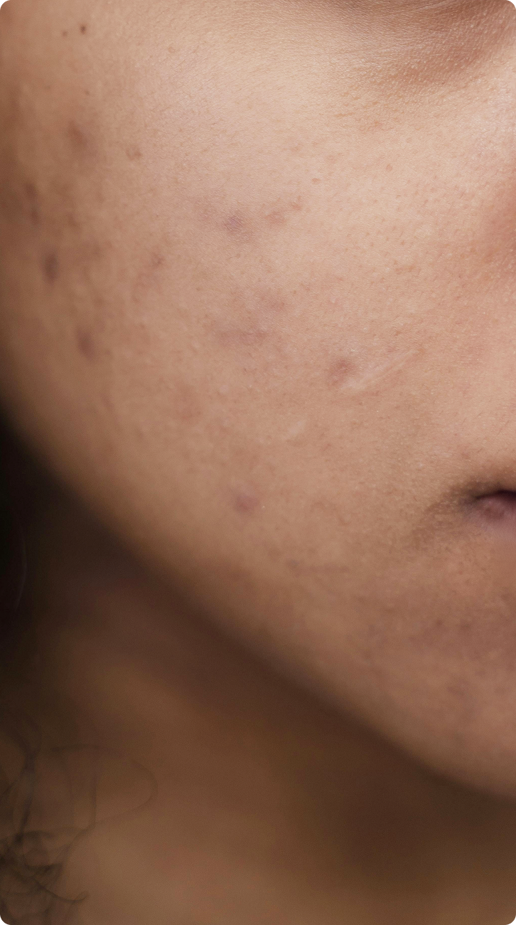 acne_mblpng.png